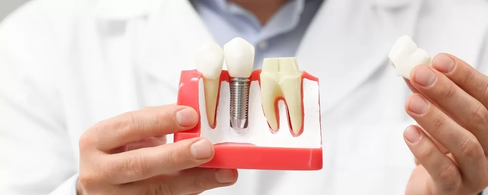 CA Oral dental implants